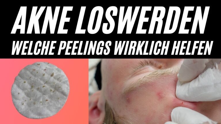 Aknebehandlungen Online Kaufen: Effektive L&ouml;sungen f&uuml;r klare Haut