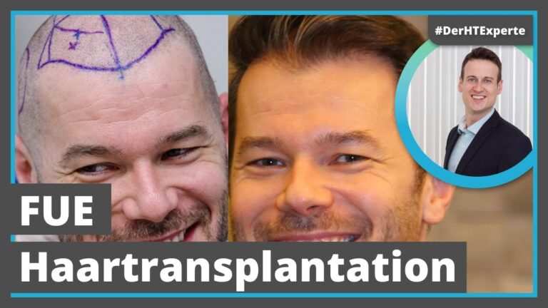 Vorteile von FUE gegen&uuml;ber FUT bei Haartransplantationen