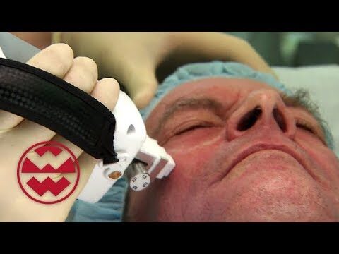 Optimale Hautpflege zur Behandlung von Akne-Narben